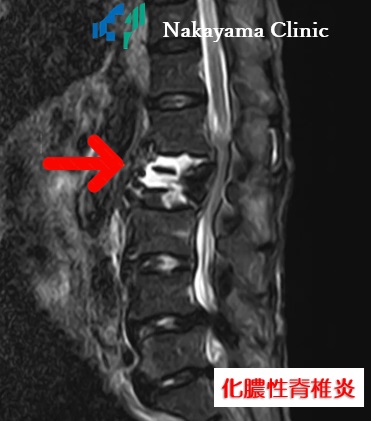 化膿性脊椎炎
