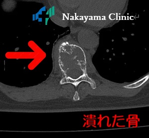 つぶれた骨