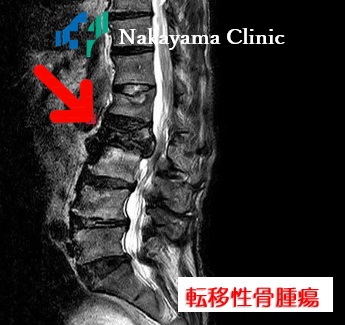 転移性骨腫瘍