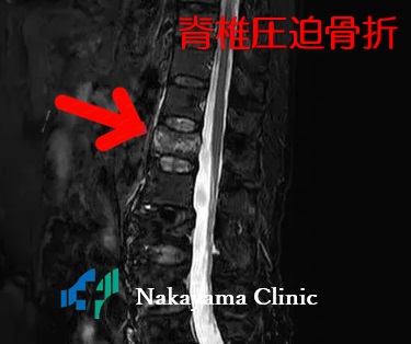 脊椎圧迫骨折MRI