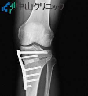 膝内側半月板後根損傷の様子