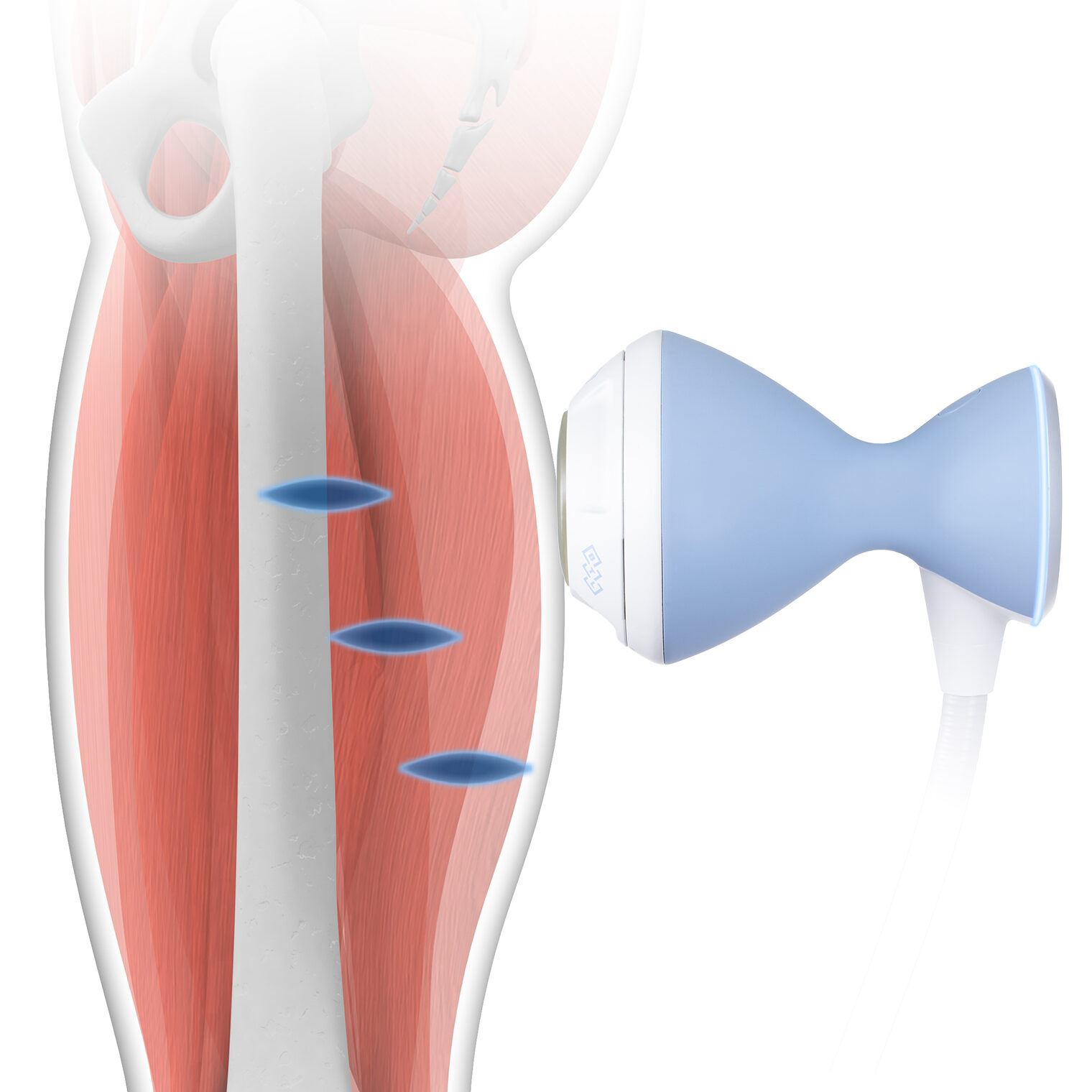 体外衝撃波治療