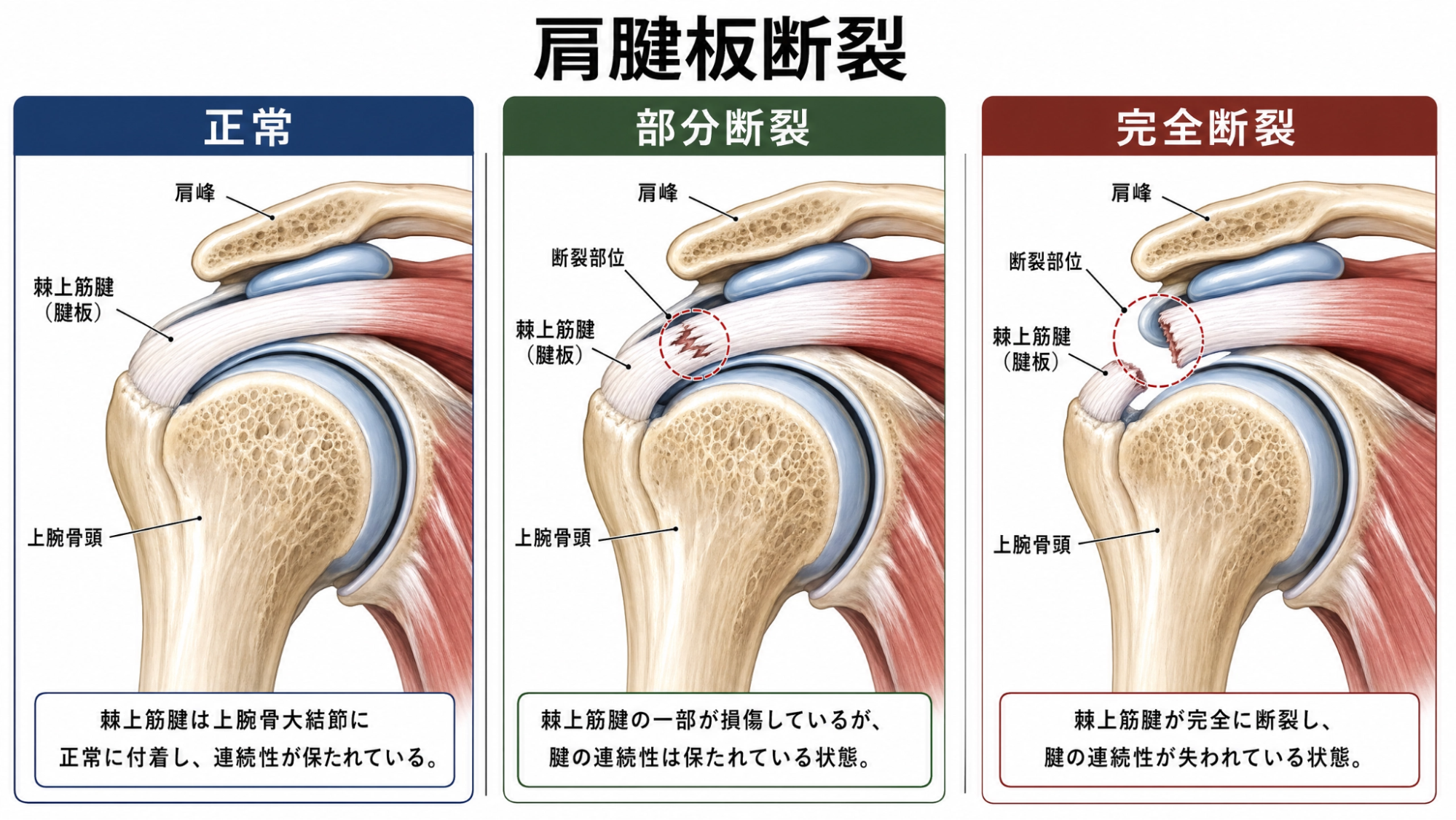 肩関節の専門治療 | 中山クリニック｜明石市の整形外科・再生医療・肩